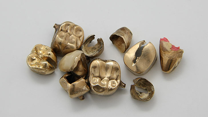Zahngold/Dentalgold: Goldzähne und Goldbrücke